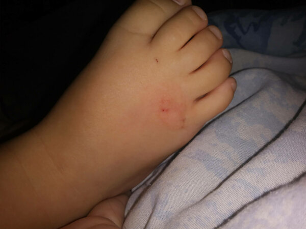 child's foot with cleared up ringworm
